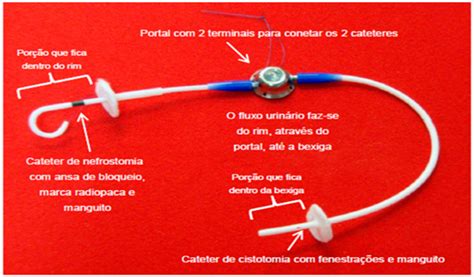 Bypass Ureteral Subcut Neo Como Tratamento Cir Rgico Em Felino