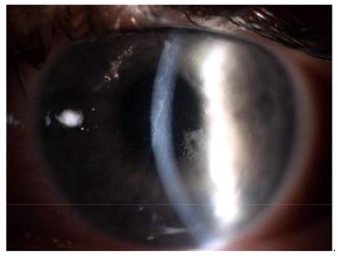 Slit Lamp Image Of The Left Eye Of A Patient Aged Years Two Days