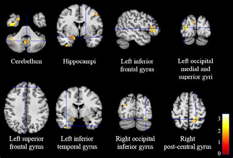 Differences In Gray Matter Gm Volume In The Asd And Control Groups