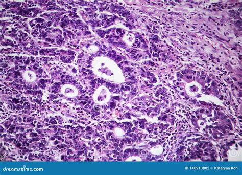 Ad Nocarcinome Gastrique Micrographe L Ger Photo Stock Image Du