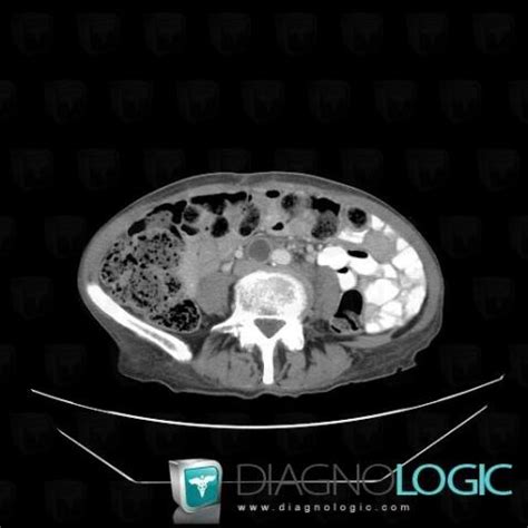 Cas radiologie Métastase Scanner Diagnologic