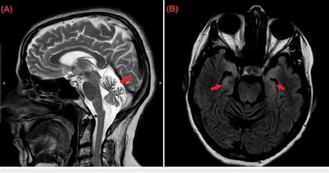 Sagittal T2-weighted images MRI (A) shows significant cerebellar ...