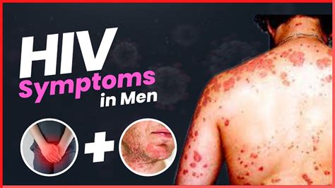 Aids Symptoms In Men