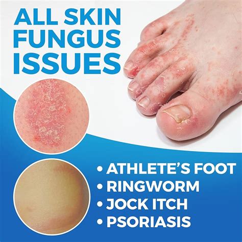 Can You Use Yeast Infection Cream On Athlete S Foot Clearance