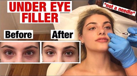 Under Eye Filler Injection For Dark Circles And Bags Before And After Injectables Fillers