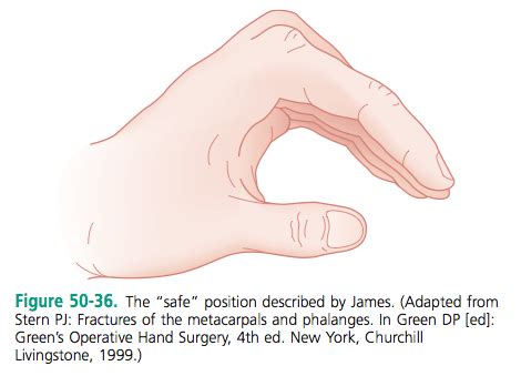 ApolloMD Splinting Flashcards Quizlet