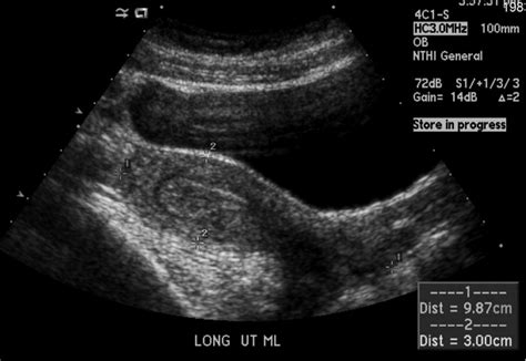 9 Week Ectopic Pregnancy Ultrasound