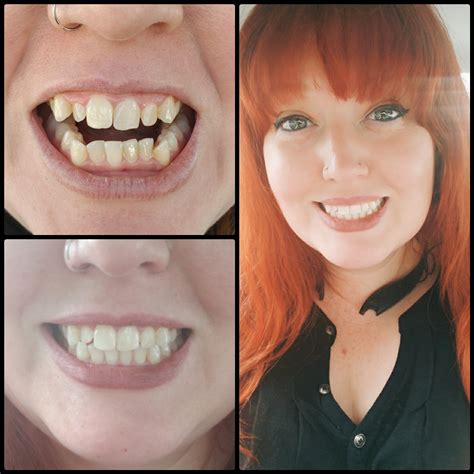 7 Months Later Success I Love My Smile Smiledirectclub