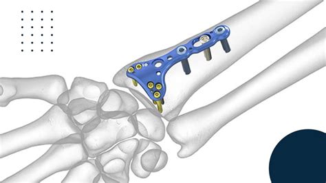 ¿conoces Las Placas Dorsales Para Fracturas De Radio Distal Doctor