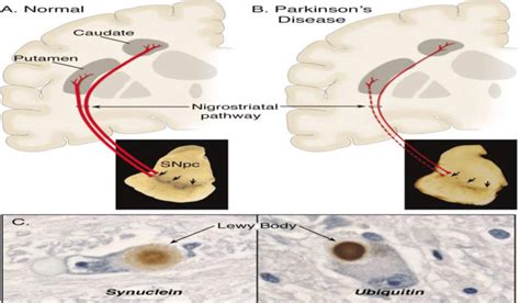 Parkinsons Disease Pathway