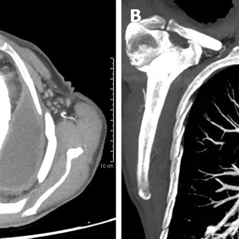 Arterial Phase Contrast Enhanced Computed Tomography A Axial View