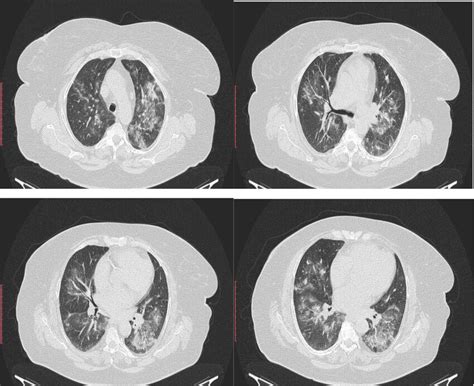 Current Presentation Ct Scan In Upper Lobes Asymmetric Centrilobular