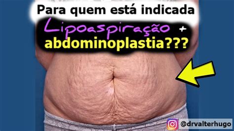 Abdominoplastia Antes Depois E Lipoaspira O Qual A Indica O Dr