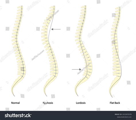 Spine Deformity Types Normal Spine Comparison Stock Vector Royalty