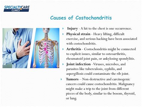 PPT - Costochondritis PowerPoint Presentation, free download - ID:10830019