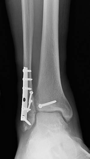 Tibia And Fibula Ankle Fracture