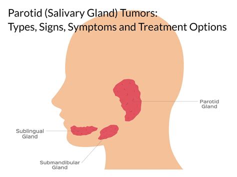 Parotid (Salivary Gland) Tumors: Types, Symptoms, and Treatments