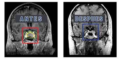 Radiocirugía Gamma Knife En Miami Tratamiento De Tumores Cerebrales