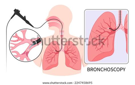 7 Mucus Plug Lungs Images, Stock Photos & Vectors | Shutterstock