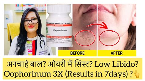 अनचह बल ओवर म ससट Low sex Drive In woman Homeopathic Medicine