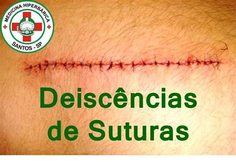 Deiscencia Da Sutura - Deiscência de sutura (abertura espontânea de pontos cirúrgicos) é ...