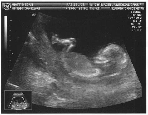 The Spamdrew Family: 13 Week Ultrasound