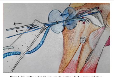 Figure From Current Evidence On Superior Capsular Reconstruction