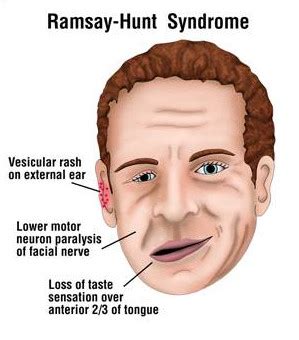 Ramsay Hunt Syndrome Causes Symptoms And Treatment