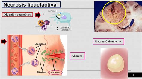 Necrosis Licuefactiva Gangrenosa Caseosa Pptx