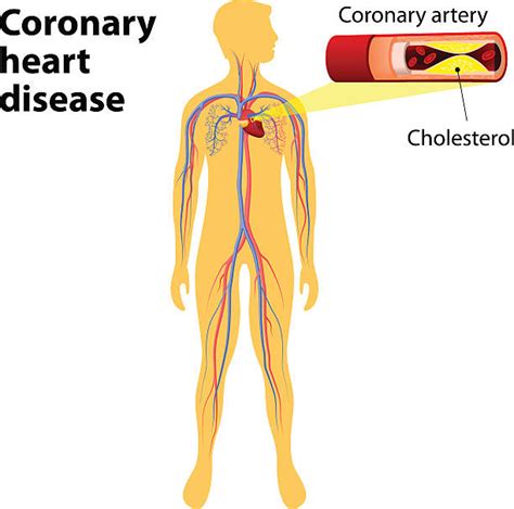 Best Atherosclerosis Illustrations, Royalty-Free Vector Graphics & Clip ...