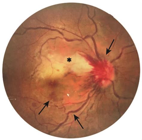 Anaemia Induced Vision Loss The Bmj