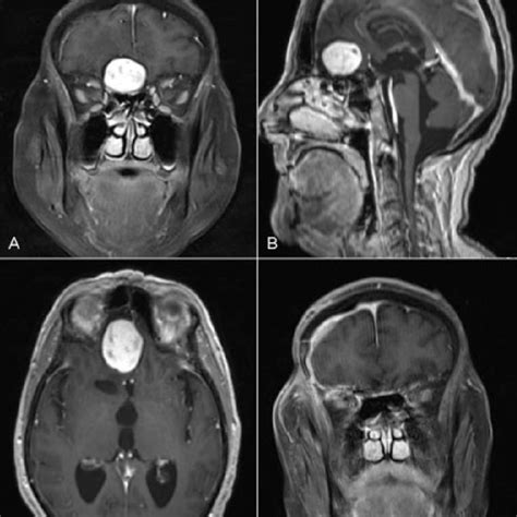 Coronal A Sagittal B And Axial C T1 Weighted Download