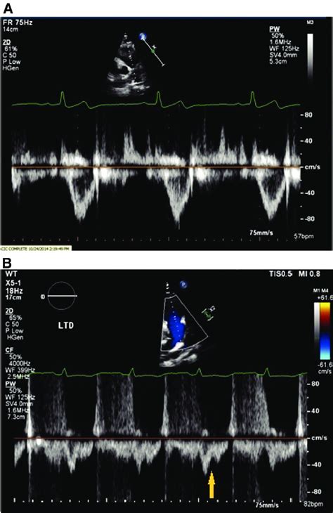 Pulsed Wave Doppler Patterns In The Right Ventricular Outflow Tract Download Scientific Diagram