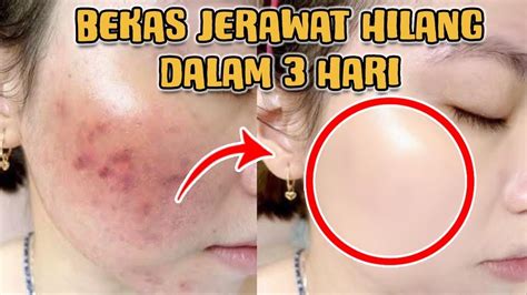 4 TIPS MENGHILANGKAN BEKAS JERAWAT PALING MUDAH DENGAN BAHAN ALAMI