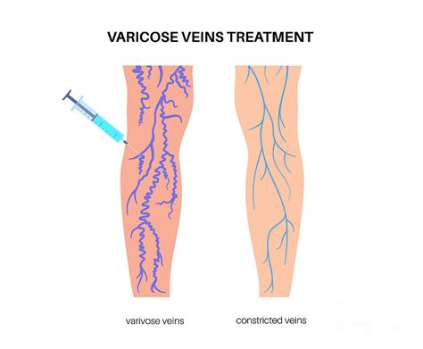 Varicose Vein Treatment Photograph By Pikovit Science Photo Library