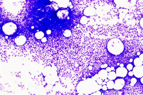 Megakaryopoiesis Hematomorphology A Databank Imagebank For