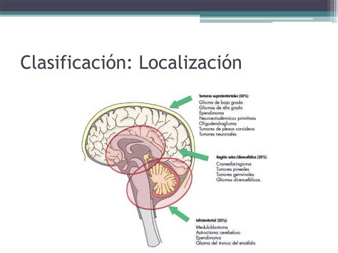 Tumores Cerebrales En La Infancia Ppt