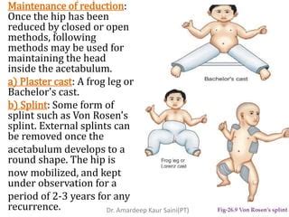 Congenital Hip Dislocation PPT