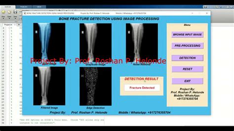 Detection Of Bone Fracture Using Image Processing Matlab Project With