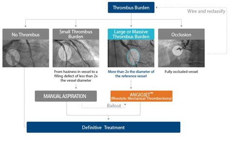 AngioJet™ Ultra Coronary Thrombectomy System | Boston Scientific