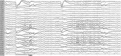 Eegfmri Study Of The Ictal And Interictal Epileptic Activity In