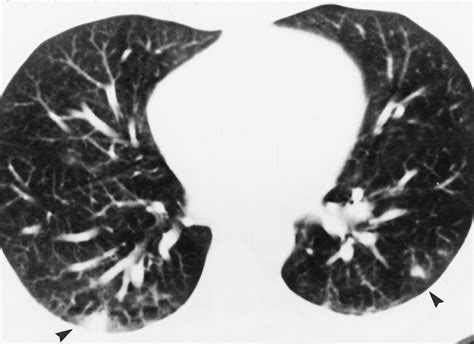 Pulmonary Drug Toxicity Radiologic And Pathologic Manifestations