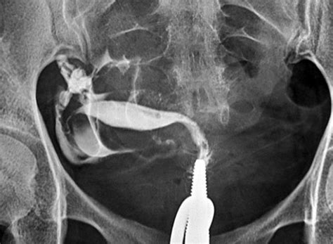 Retroverted Uterus Hsg