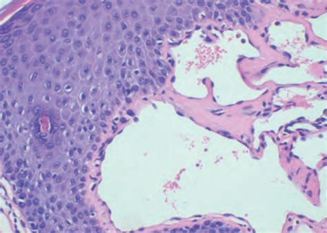 Scielo Brasil Genital Angiokeratoma In A Woman With Fabry Disease