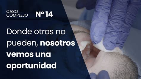 Caso Dental Complejo N P Descubre La T Cnica Secreta Para Extraer