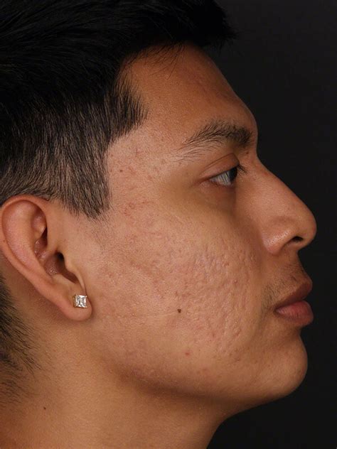 Before After Rf Microneedling Treatment In Irvine Total Dermatology