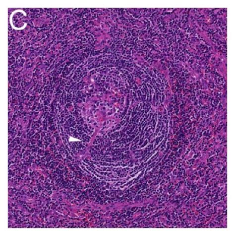 A And B Aortic Angiogram With Selective Bronchial Arteriogram