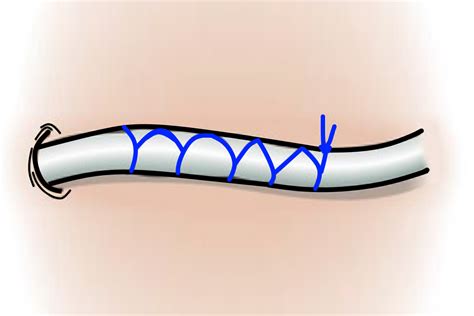 Common Suture Patterns Surgmedia