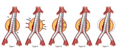 Endoleaks Thoracic Key