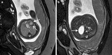 0 A 26 Week Fetus With Asplenia Syndrome Fetal Cmr B Tfe Four Chamber Download Scientific